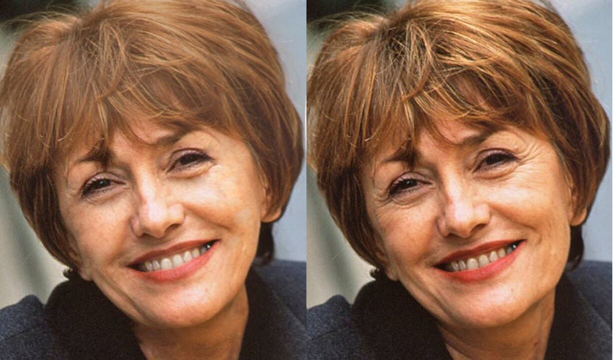 yüzün kontür öncesi ve sonrası fotoğrafı